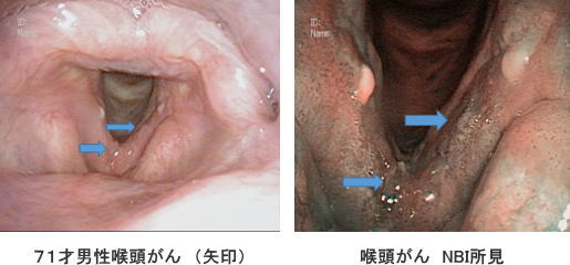 症 声帯 白板